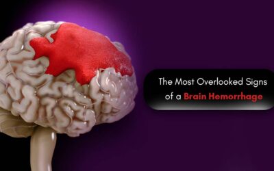 The Most Overlooked Signs of a Brain Hemorrhage